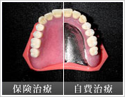 メタルプレート (金属床義歯)