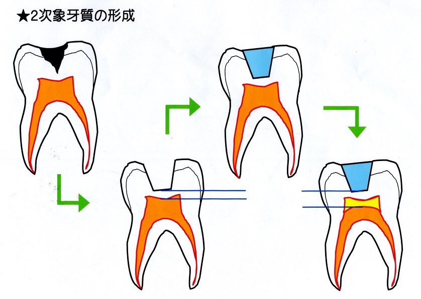 虫歯の治療後に歯がしみるようになったが大丈夫？｜尼崎 塚口の歯科 富永歯科医院