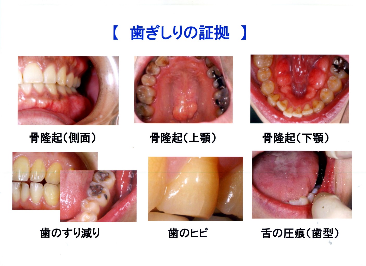 歯ぎしり』について｜尼崎 塚口の歯科 富永歯科医院