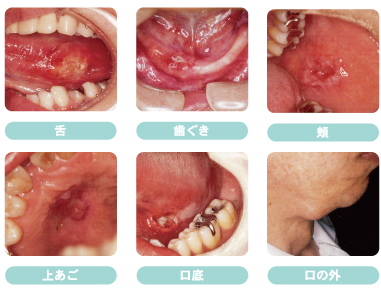 お口の中のガンについて ～口腔ガンに注意～｜ 尼崎 塚口の歯科 富永